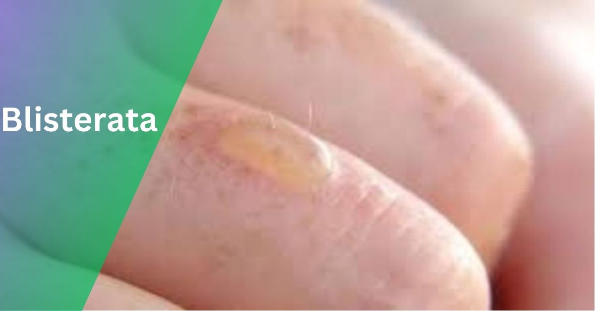 Blisterata – A Comprehensive Guide To Causes And Remedies!